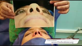 جراحی بینی گوشتی قوز دار توسط دکتر امید ابراهیمی بهترین جراح بینی
