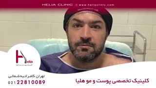 کاشت مو به روش میکروگرافت | کلینیک هلیا | 02122810089 | شماره 58