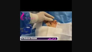 فیلم عمل جراحی بینی با نوک گوشی (قسمت دوم)