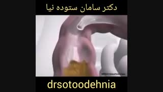 تمیز کردن روده بزرگ با کولونوسکوپی