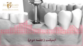 ایمپلنت دندان در جلسه دوم