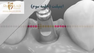ایمپلنت دندان در جلسه سوم