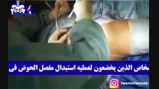 استبدال مفصل الحوض فی الشباب