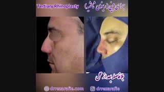 جراحی بینی | دکتر رفیع