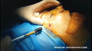 تزریق چربی به لب و گونه و جراحی بینی
