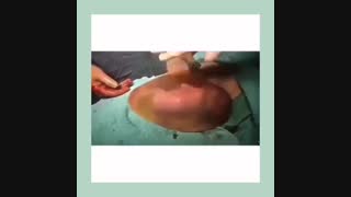 زایمان زودرس نوزاد سالم با کیسه اب کامل