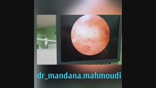 عمل هیسترکتومی