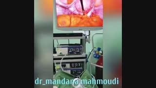 پایان عمل و رحم و تخمدان سالم