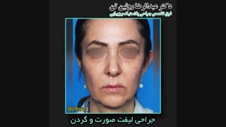 جراحی لیفت صورت و گردن