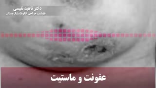 عفونت و ماستیت پستان