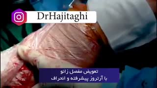 فیلم عمل تعویض مفصل زانو