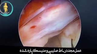 عمل مجدد رباط صلیبی و منیسک پاره شده