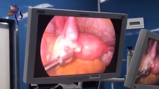 لاپاراسکوپی کیست تخمدان