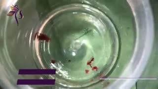 هیستروسکوپی در یک خانم 60 ساله