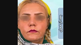 فیلم جراحی زیبایی بینی