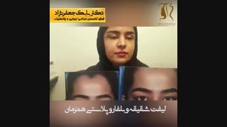 لیفت شقیقه و بلفاروپلاستی