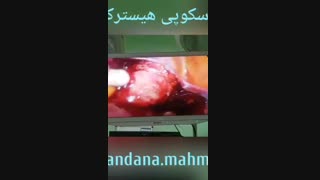 عمل جراحی لاپاراسکوپی هیسترکتومی به جای جراحی باز