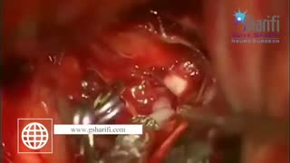 فیلم جراحی به دلیل خونریزی زیر عنکبوتیه