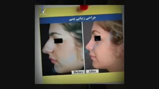 نموذج من جراحه تجمیلیه الانف