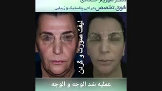 عملیه شد الوجه و العنق