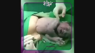 وقتی کودک با کیسه اب بدنیا میاید