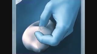 انیمیشن جراحی وازکتومی با نمای ساده