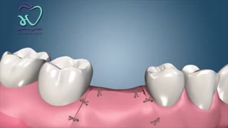انیمیشن ایمپلنت دندان
