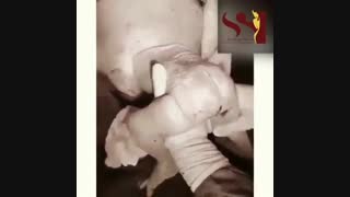 بدنیا اومدن نوزاد با پا در حالت سزارین