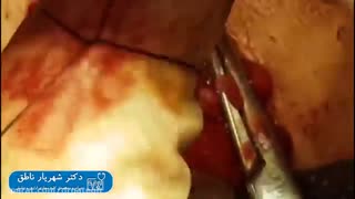 جراحی واریکوسل