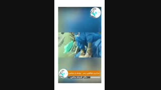 زایمان سزارین دوقلویی