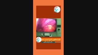 نمونه عمل لاپاراسکوپی یا خارج کردن رحم