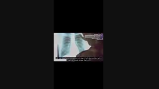 کرونا ویروس