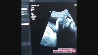 فیلم سونوگرافی صورت جنین