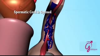 فیلم عمل جراحی واریکوسل