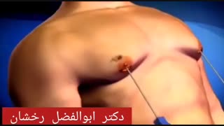فیلم عمل جراحی ژنیکوماستی
