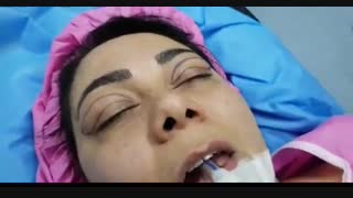 جراحی پلک | دکتر شهریار یحیوی