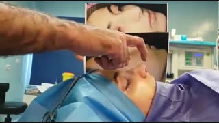 عمل زیبایی بینی قوز دار و پهن توسط جراح بینی تهران دکتر امید ابراهیمی