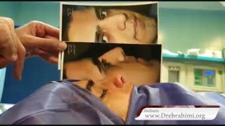 اصلاح کجی شدید بینی توسط جراح بینی تهران دکتر امید ابراهیمی