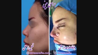 جراحی بینی و پلک توسط دکتر رضا رفیع
