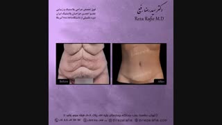 جراحی زیبایی شکم توسط دکتر رضا رفیع