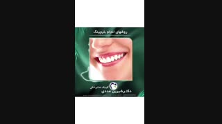 روش های بلیچینگ دندان