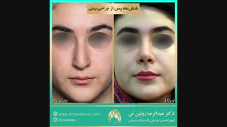 جراحی بینی | فوق تخصص جراحی پلاستیک | دکتر عبدالرضا روئین تن