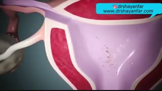 همه چیز در مورد بارداری خارج از رحم