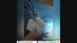 عمل پروتز سینه توسط دکتر هادیزاده بهترین جراح پروتز سینه تهران