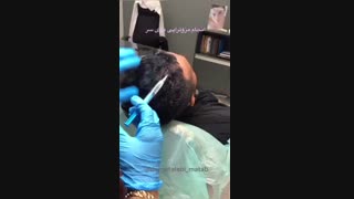 مزوتراپی مو