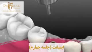ایمپلنت دندان در جلسه چهارم