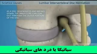 دردهای سیاتیکی