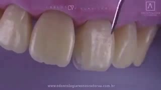ترمیم دندان شکسته جلو