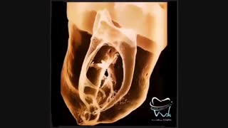 درمان ریشه اندو چیست