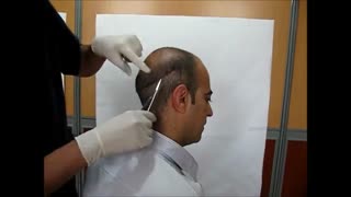کشیدن بخیه در کاشت مو